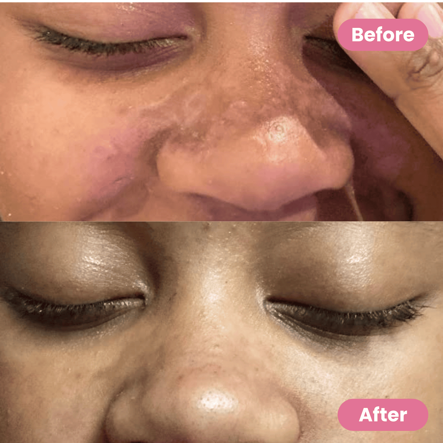 Medical-Grade Silicone Scar Sheets