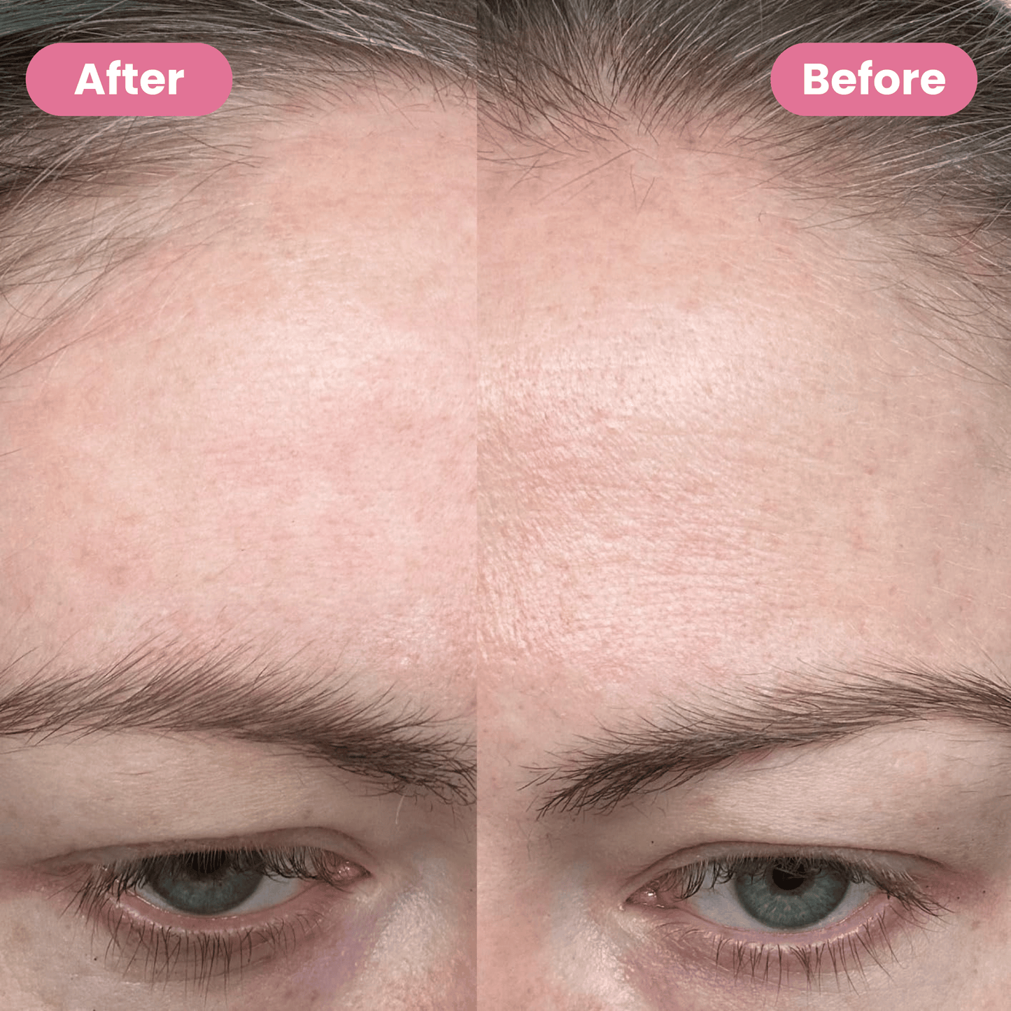 Medical-Grade Silicone Scar Sheets