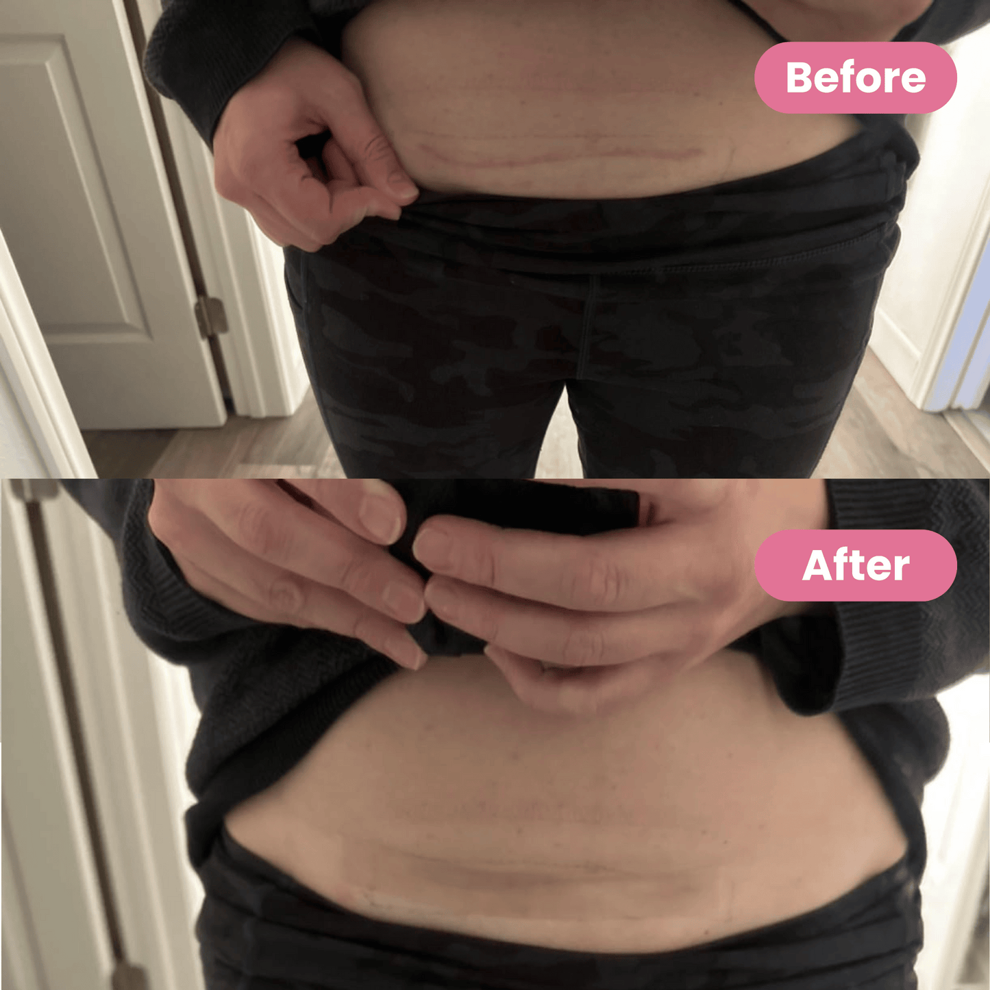 Medical-Grade Silicone Scar Sheets