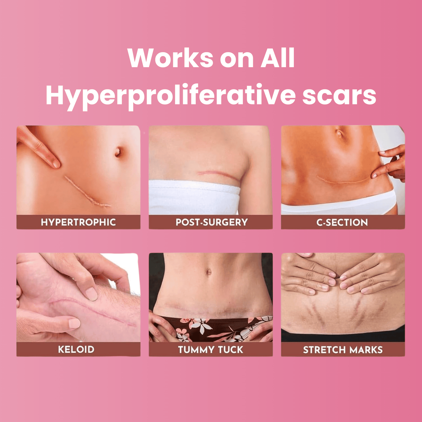 Medical-Grade Silicone Scar Sheets